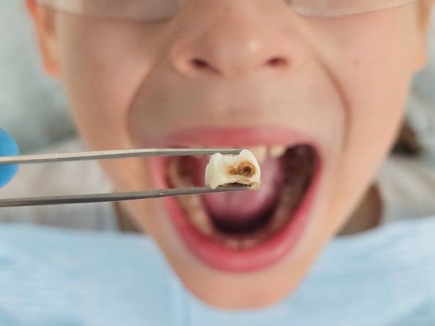 Best Dentist for Tooth Abscess  in Bellevue, WA